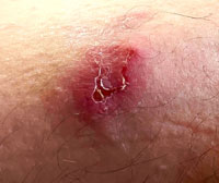 Spider Bite
